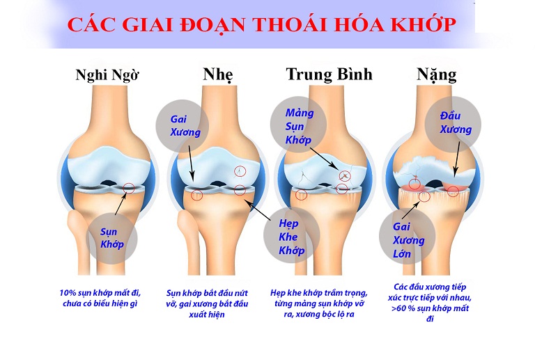 dieu-tri-thoai-hoa-khop-de-dang-voi-bam-huyet-massage-1